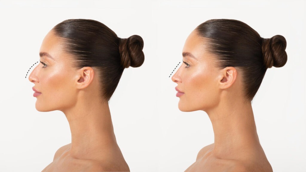 Rinoplastia funcional vs estética descubre cuál necesitas