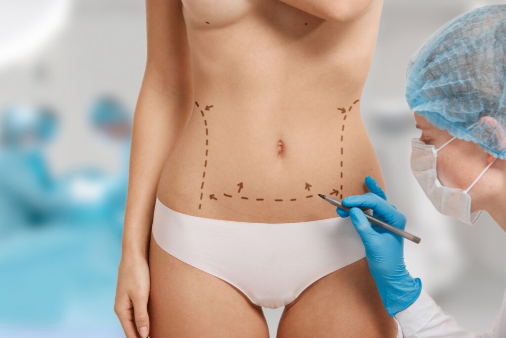 Lipoabdominoplastia ¿Cuáles son los Riesgos y Cómo Mitigarlos